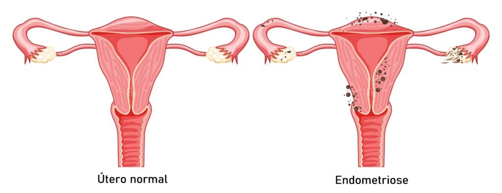 Imagem que representa útero normal e um útero com endometriose. Imagem que representa útero normal e um útero com endometriose.