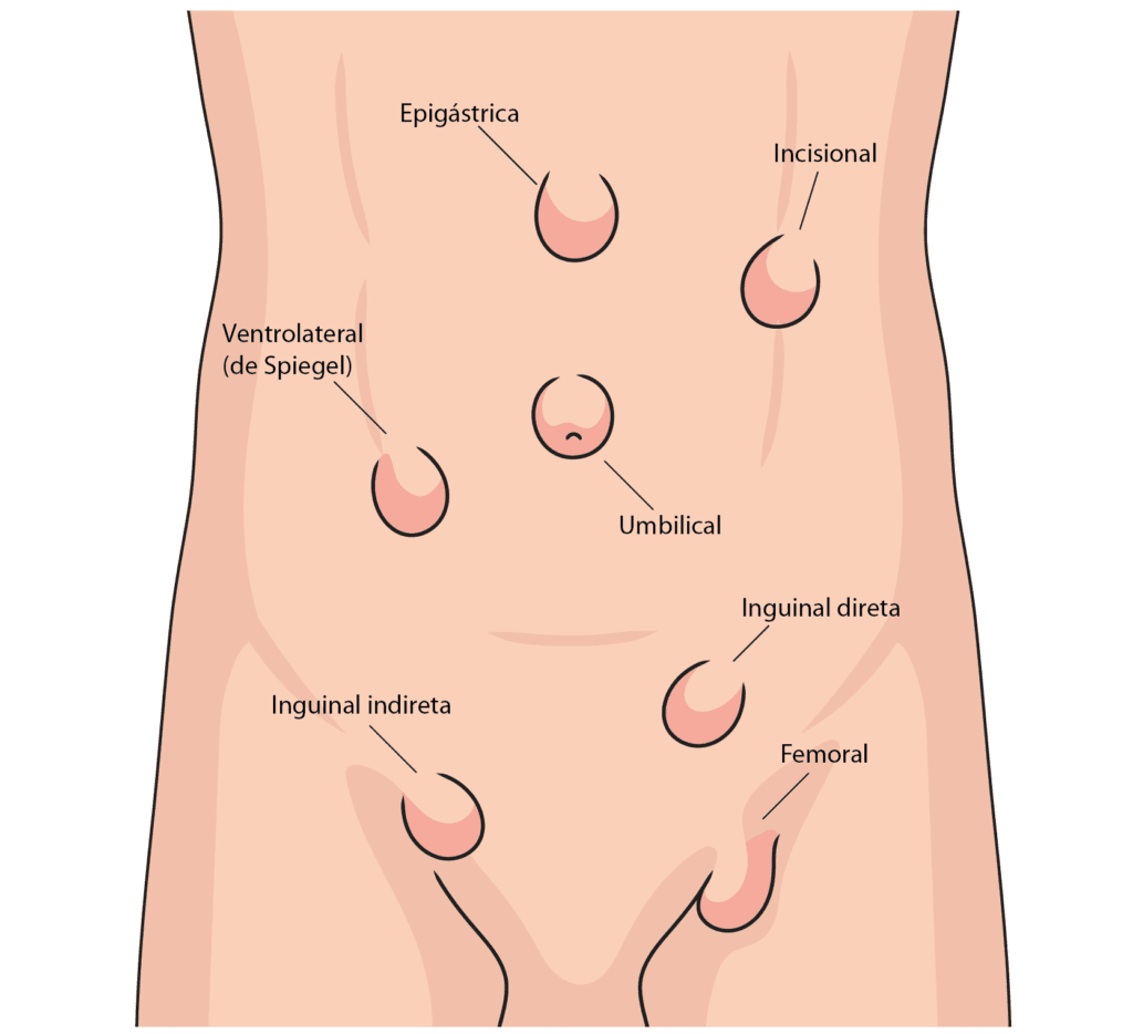 Tipos de Hérnia abdominal