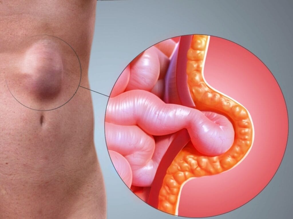 Hérnia abdominal