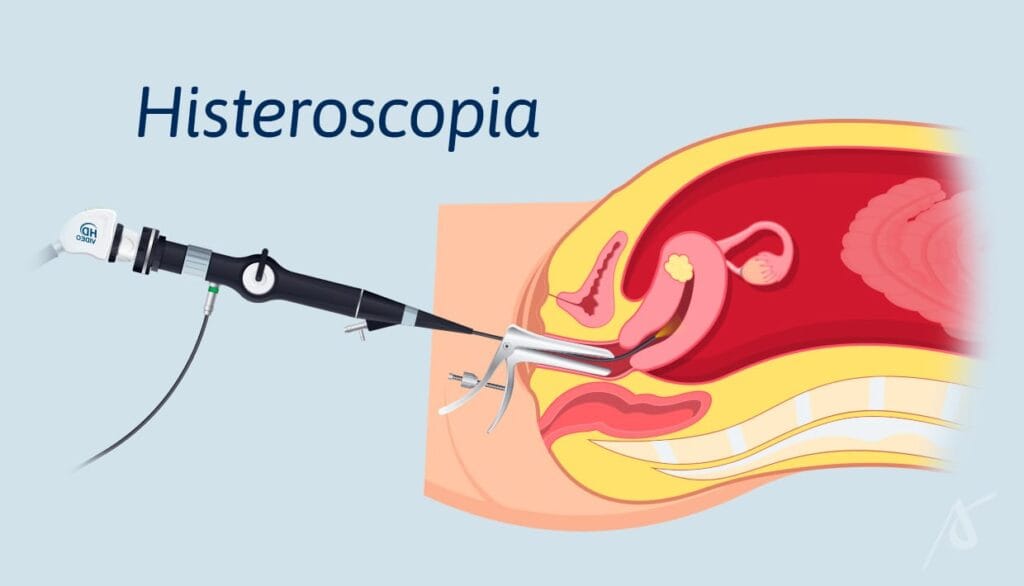 A histeroscopia é um procedimento médico que permite visualizar o interior do útero.