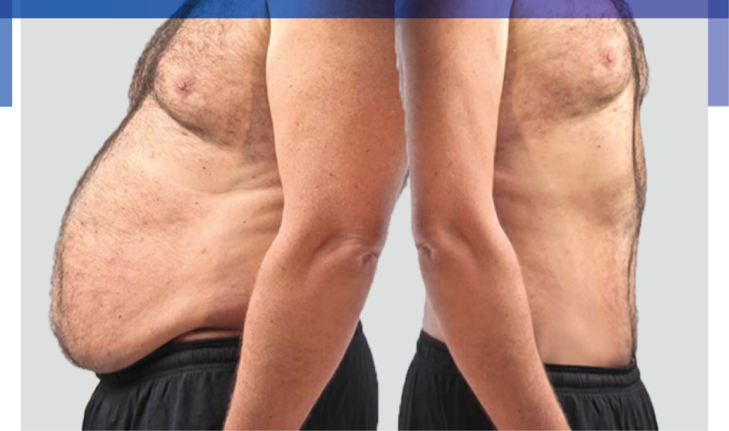 Cirurgia bariátrica antes e depois Cirurgia bariátrica antes e depois