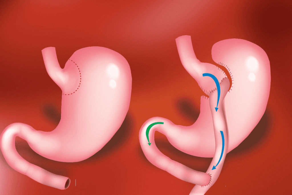 Cirurgia bariátrica Bypass Cirurgia bariátrica Bypass